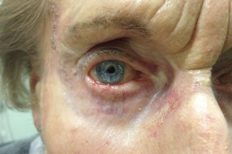 Inflammation of the Eyelid (Blepharitis)