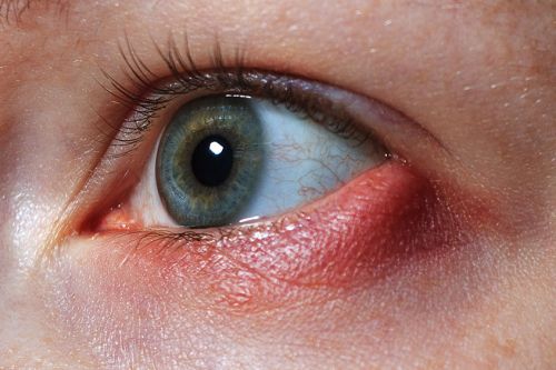 Eyelid Lumps and Cysts (Chalazion)