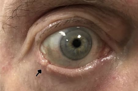 Eyelid tumours
