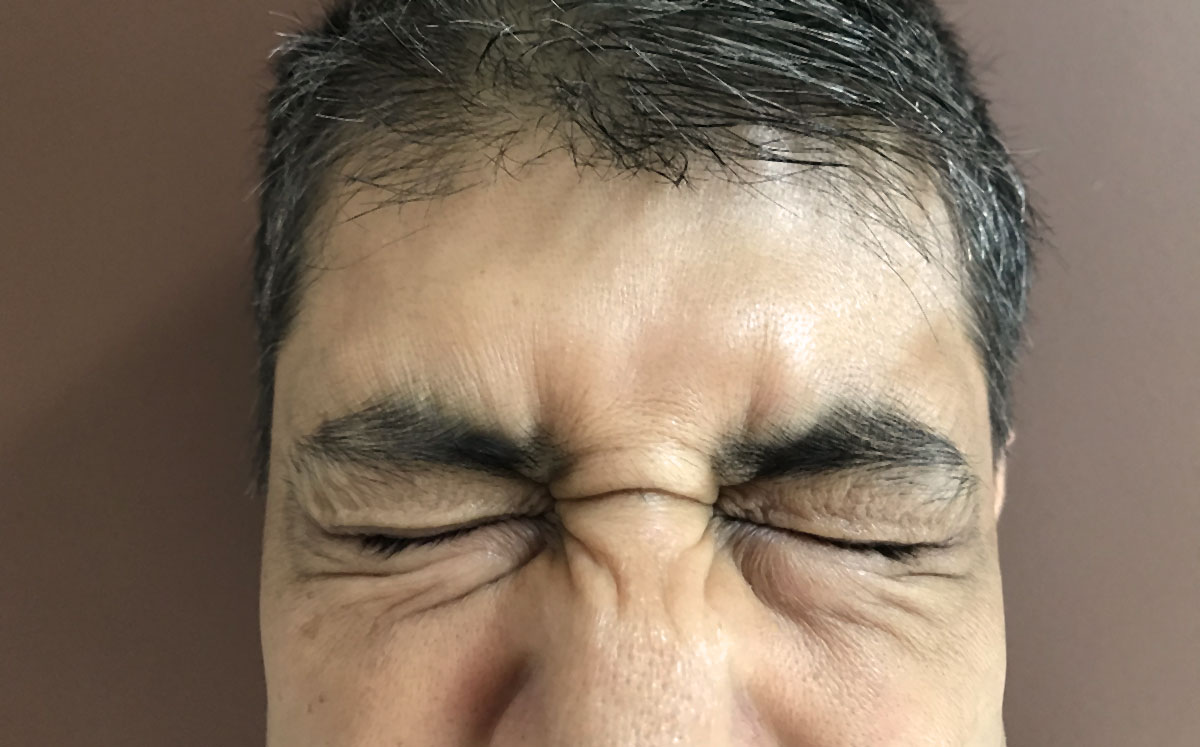 Involuntary Blinking (Blepharospasm) Consultant Ophthalmologist Nottingham