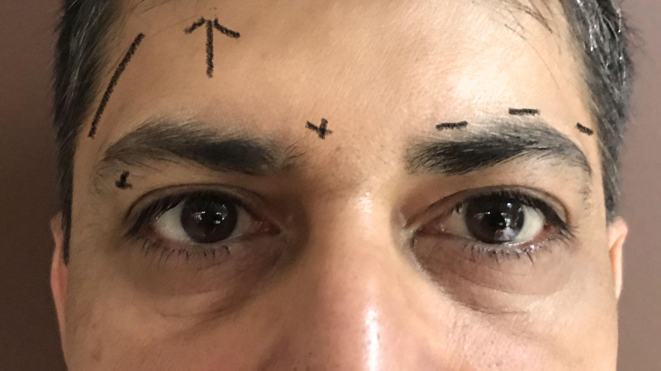 Brow Lift Surgery