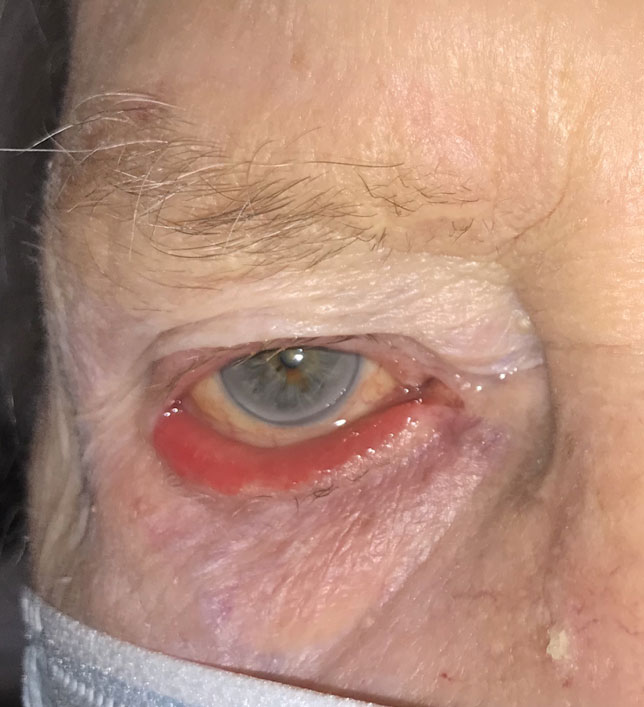 Ectropion (Outward turning of the eyelid)