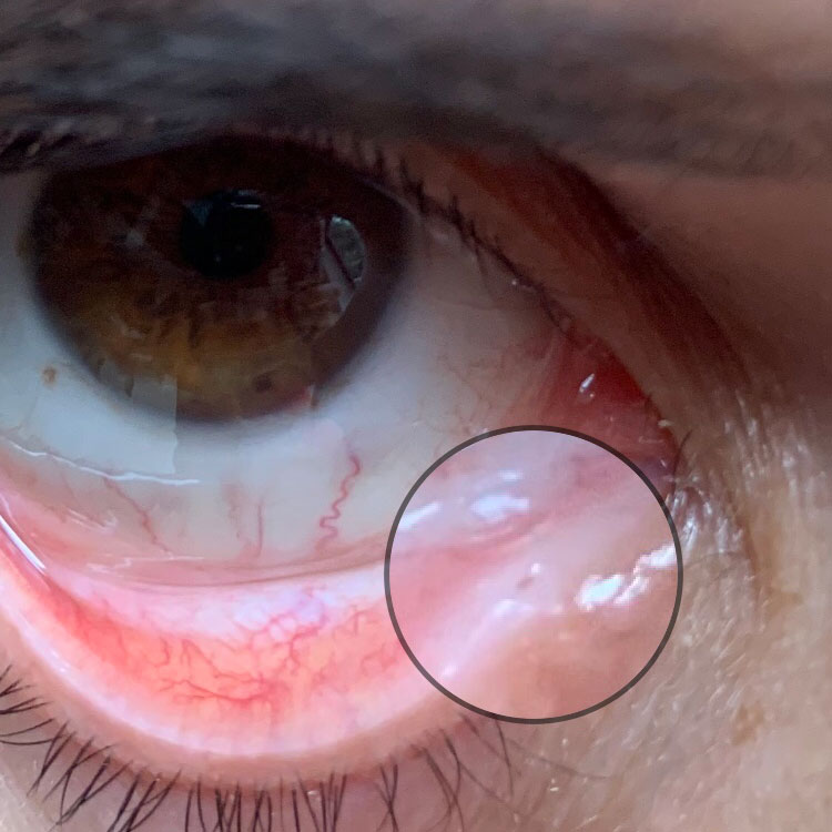 Punctoplasty